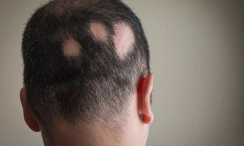 Alopesi (Saçkıran) Nedir, Belirtileri Nelerdir?