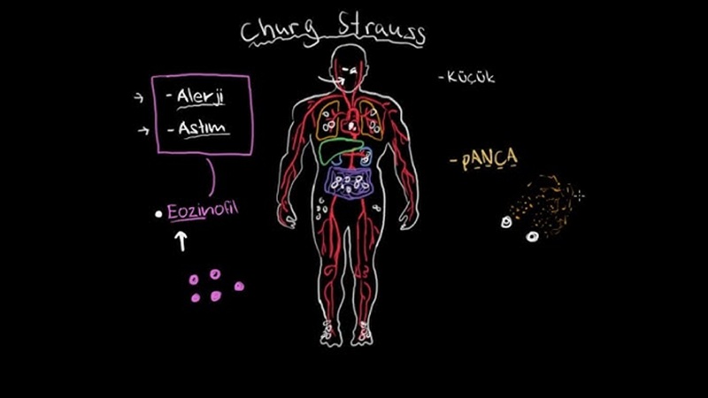 Churg-Strauss Sendromu (EGPA) Nedir? Belirtileri, Nedenleri ve Tedavisi