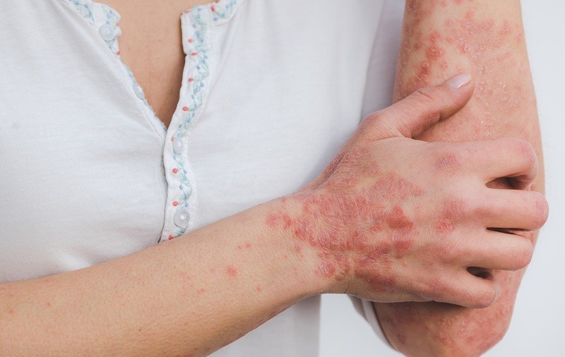 Kelebek Hastalığı (Lupus): Nedenleri, Belirtileri Nedir?