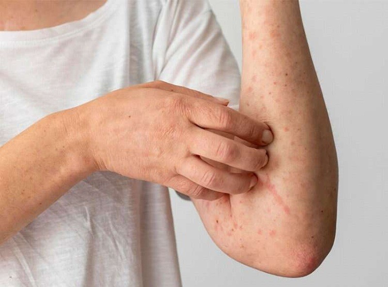 Kelebek Hastalığı (Lupus): Nedenleri, Belirtileri Nedir?