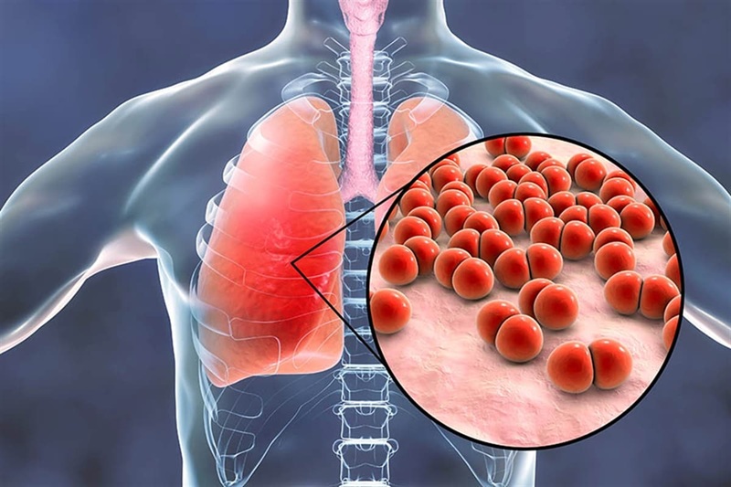 Zatürre (Pnömoni) Nedir?: Nedenleri, Belirtileri, Tedavisi ve Korunma Yolları